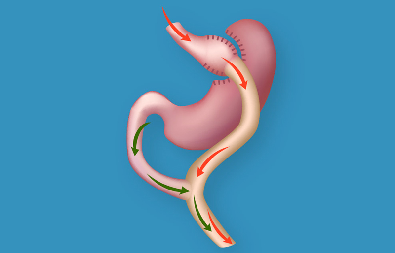 Banda Gastrica Puerto Vallarta